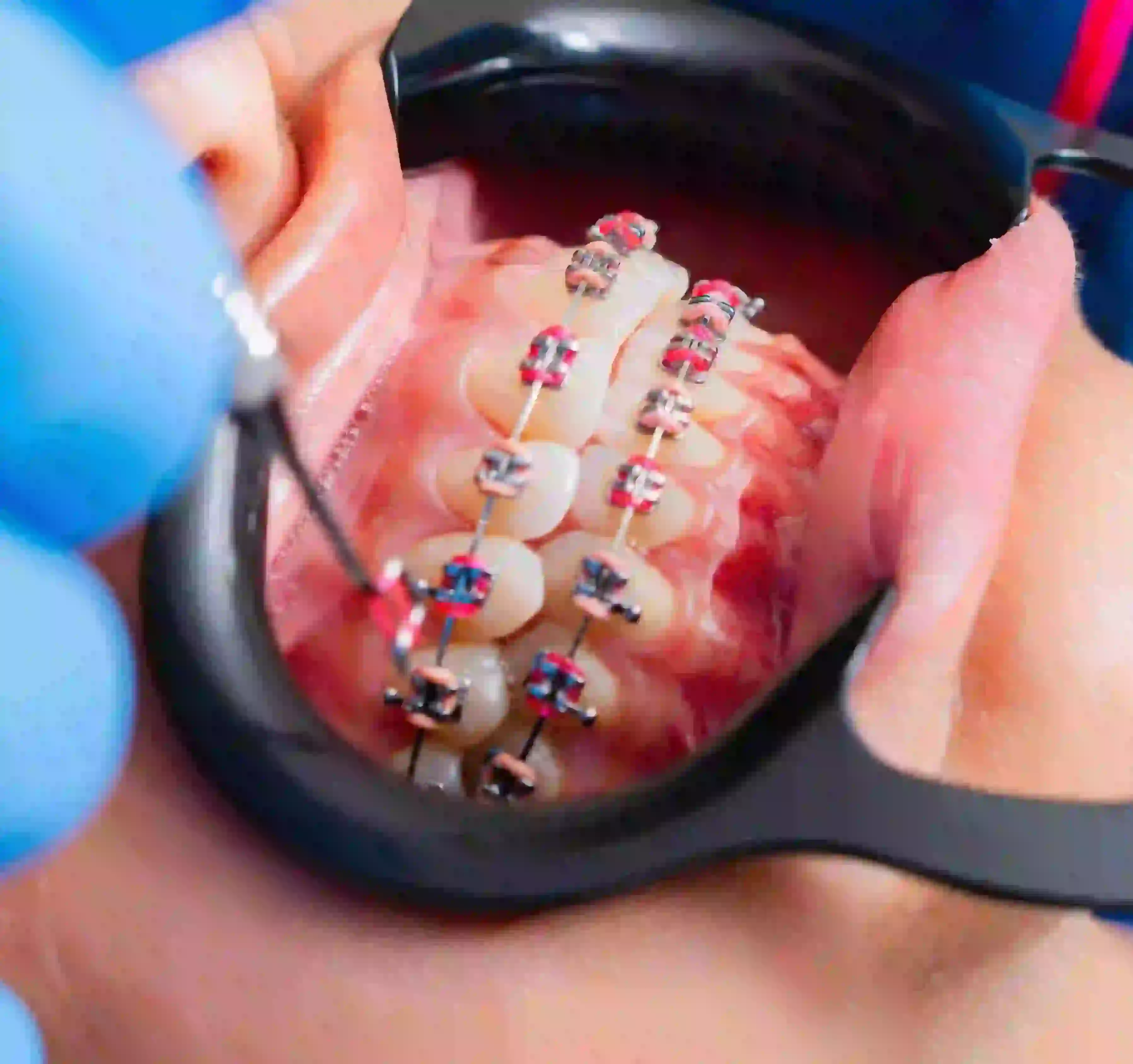 Orthodontic Braces at PanOral