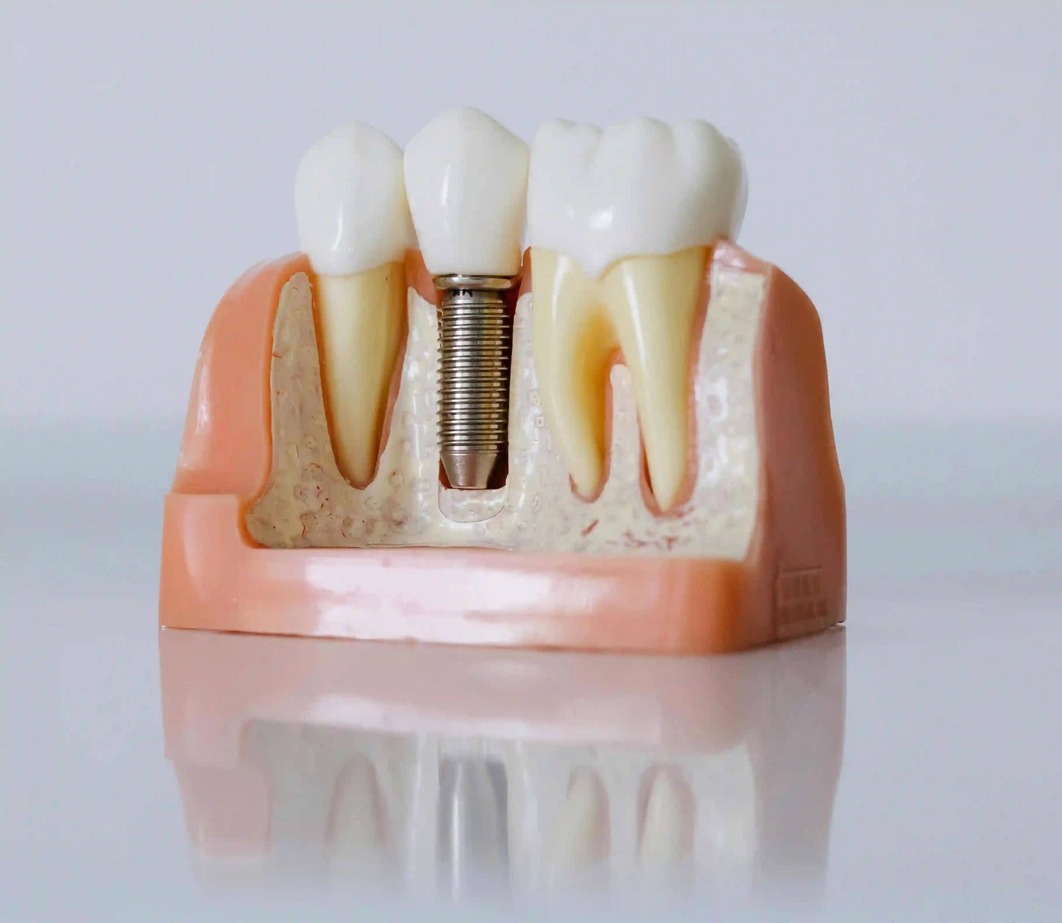 Dental Implants at PanOral
